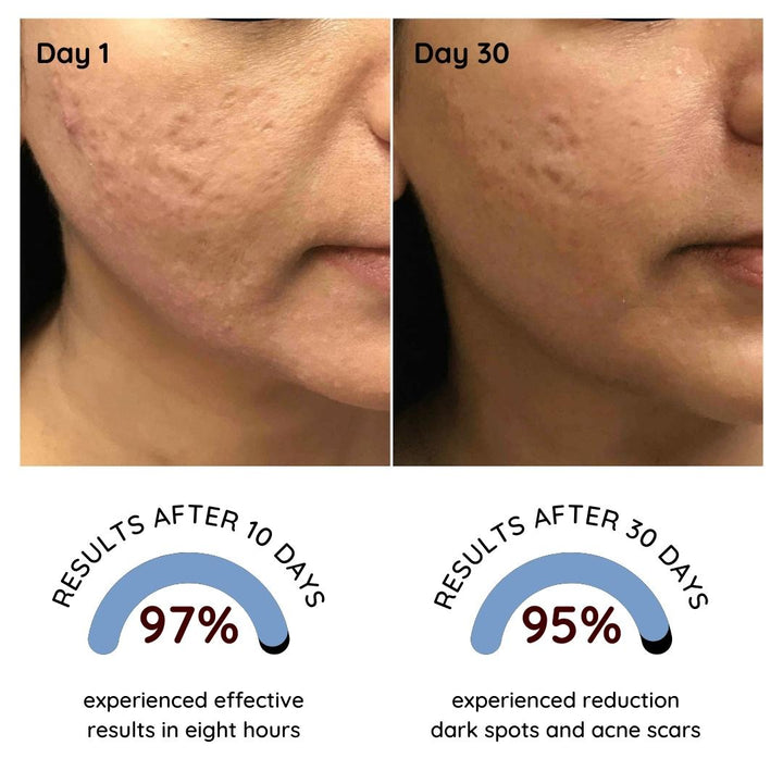 Clear & Glow Acne Gel
