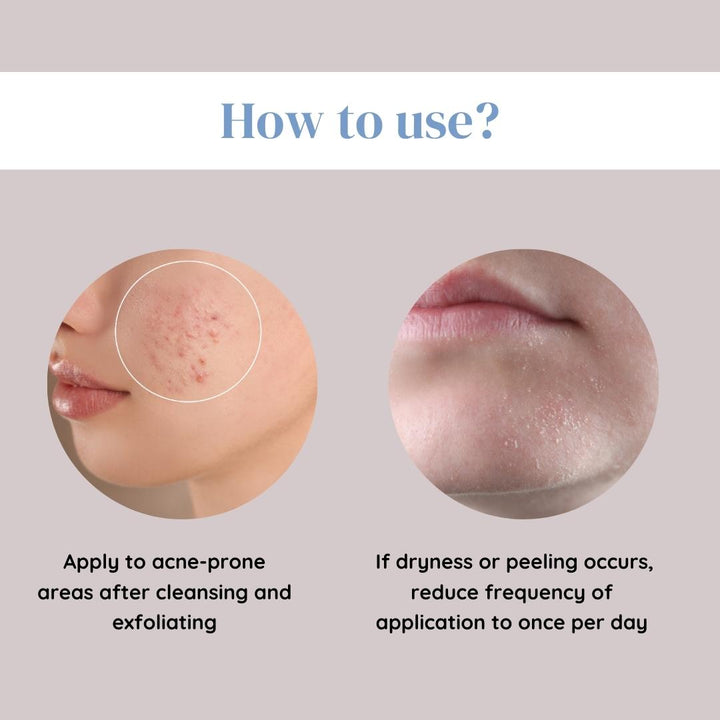 Clear & Glow Acne Gel