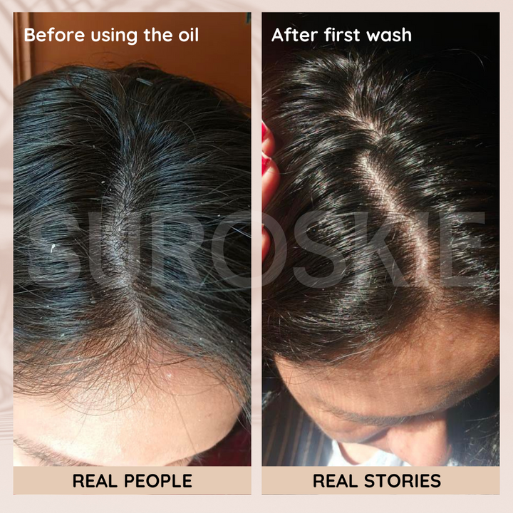 Dandruff Defence - Anti Dandruff Hair Oil