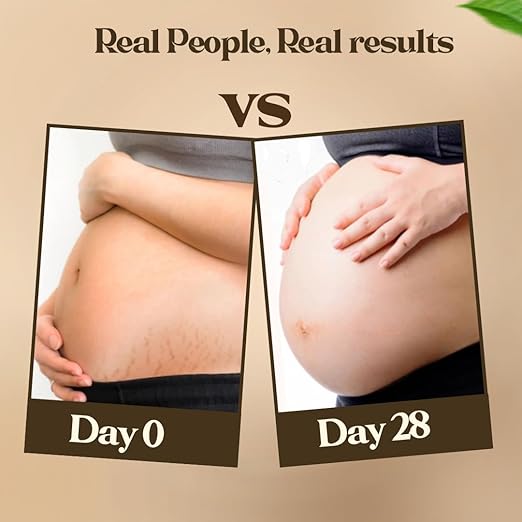 Pokonut Ayurvedic Stretch Mark Cream - 50 gms
