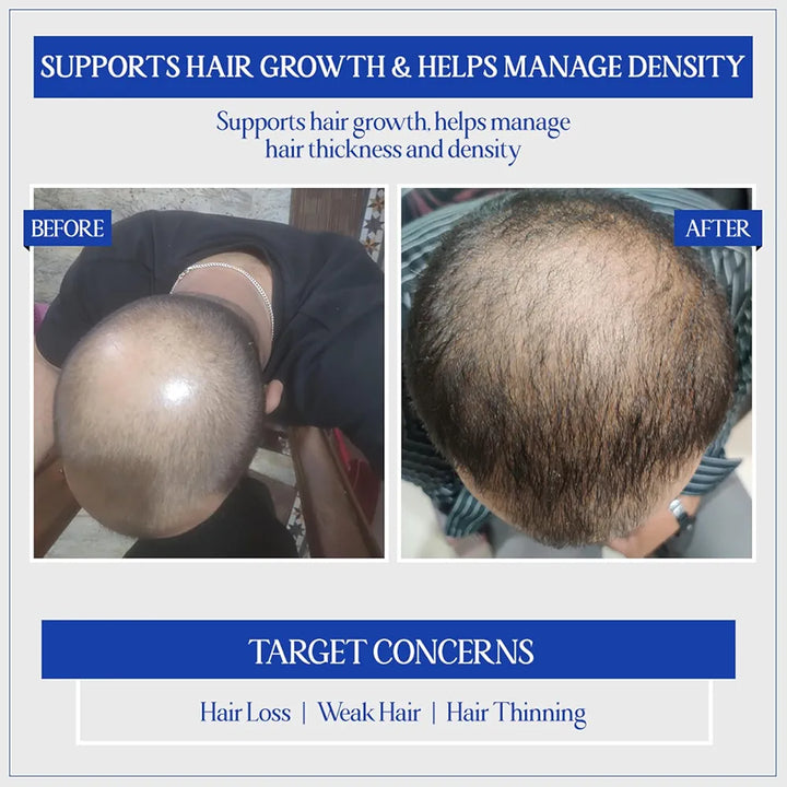 TYC - TRUST YOUR CHOICE Herbal Hair Growth Serum with 3% Redensyl, 1% Procapil & 1% Capilia Longa | Manages Hair Fall, Thinning & Loss | Encourages Hair Growth | pH 5.5, 50 ml